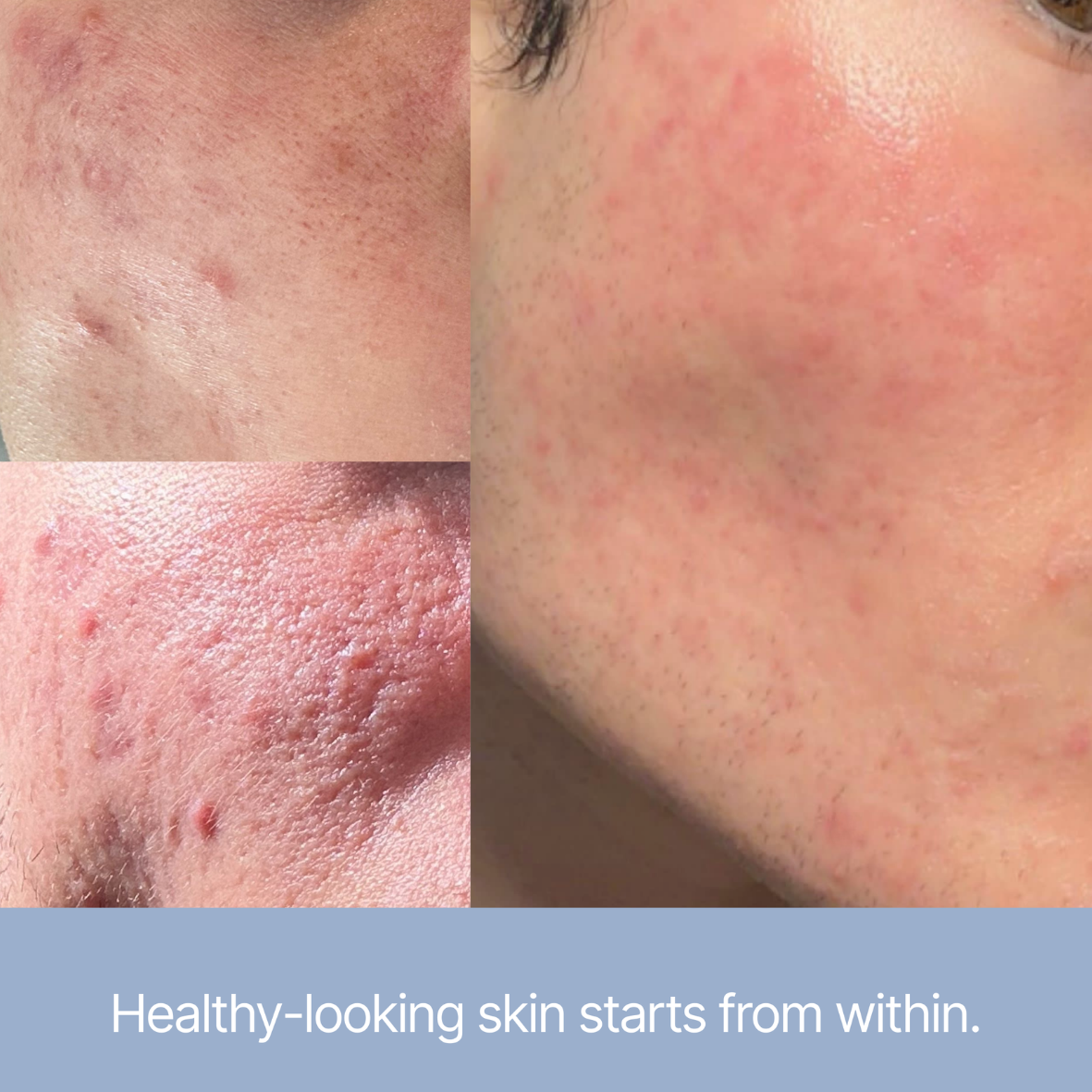Heldere huid - Acne & Onzuiverheden - NIEUW