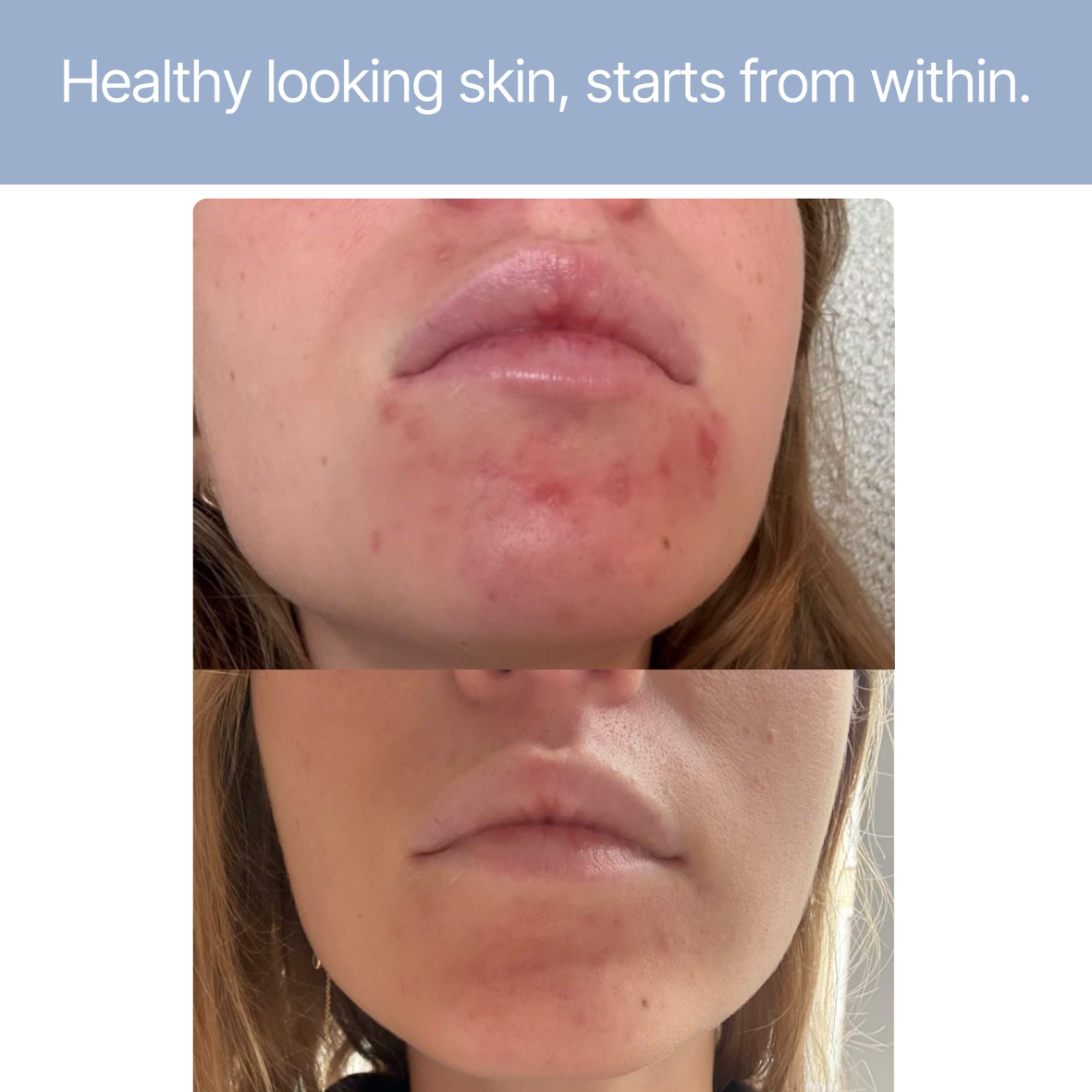 Heldere huid - Acne & Onzuiverheden - NIEUW