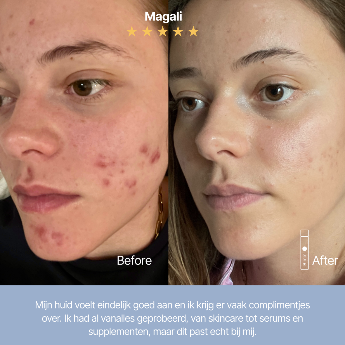 Heldere huid - Acne & Onzuiverheden - NIEUW