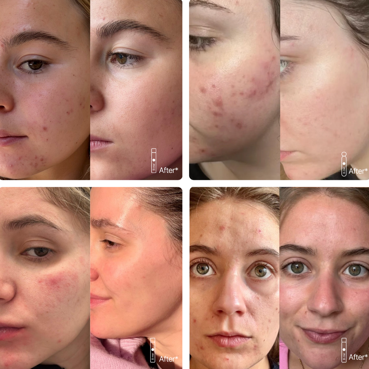 Heldere huid - Acne & Onzuiverheden - NIEUW