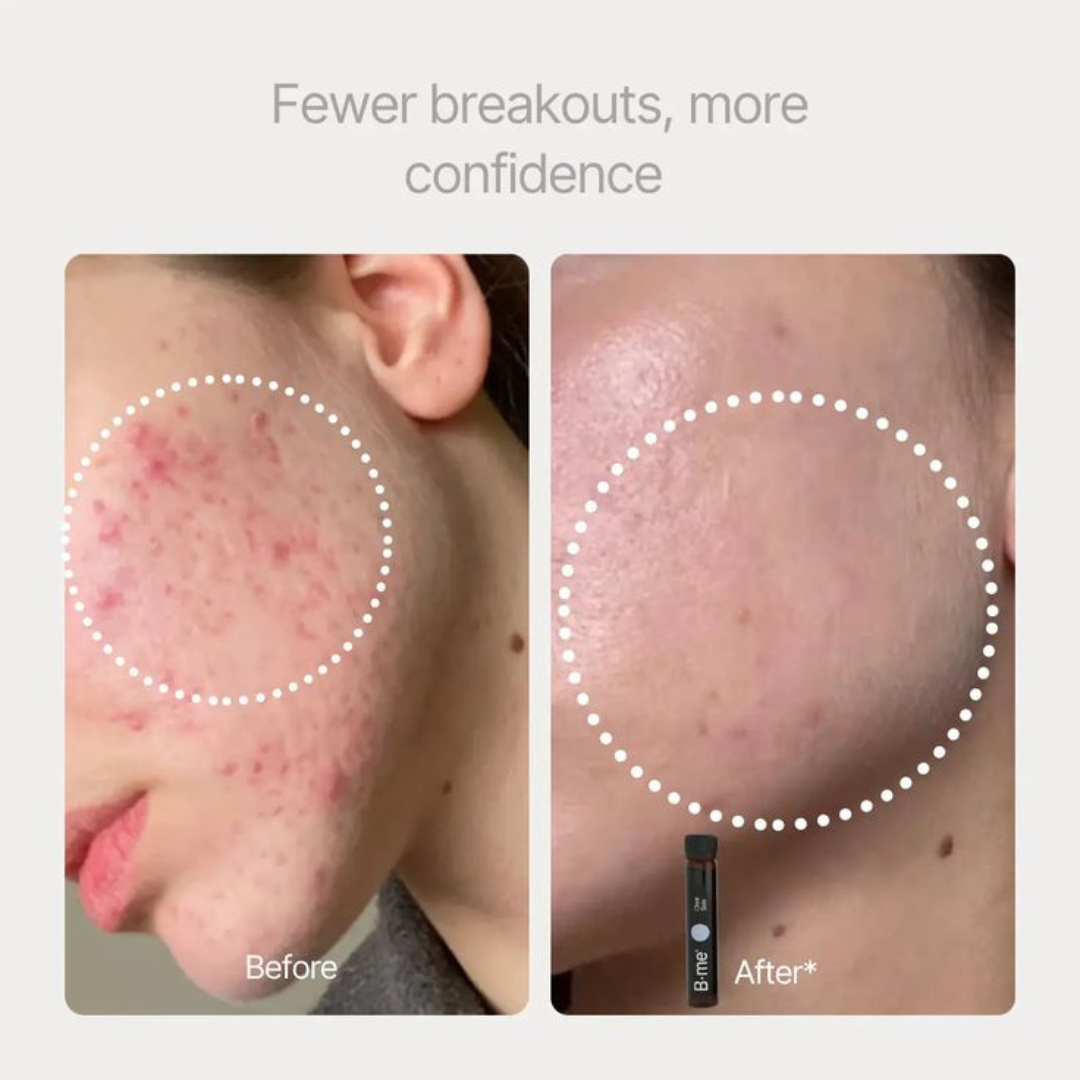 Heldere huid - Acne & Onzuiverheden - NIEUW