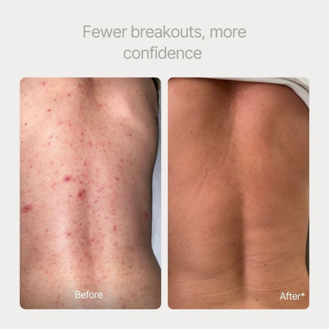 Heldere huid - Acne & Onzuiverheden - NIEUW